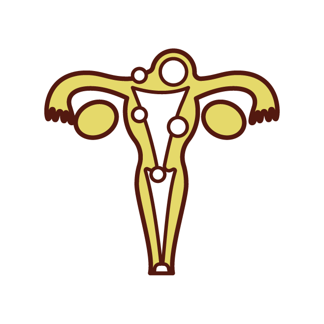 Uterine fibroid illustration