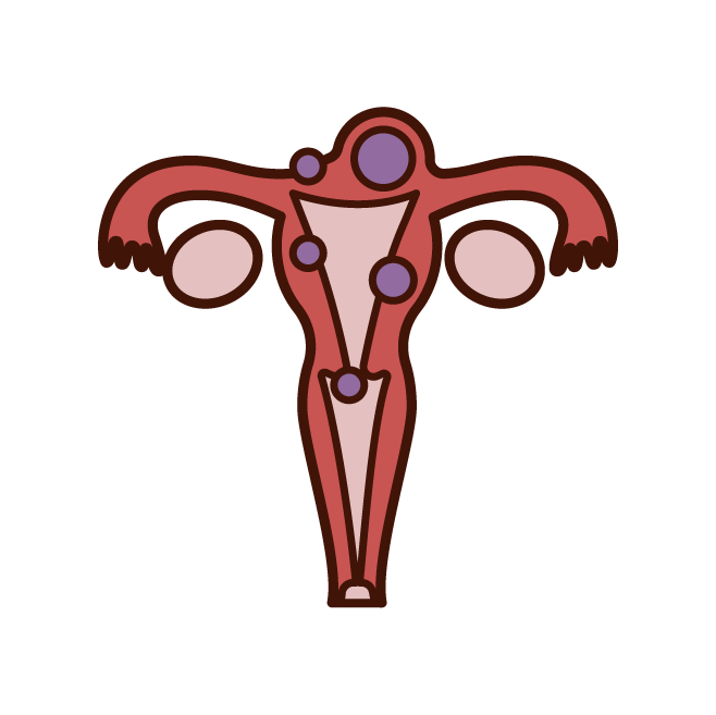 Uterine fibroid illustration