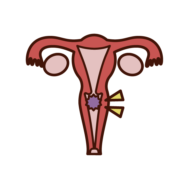 Cervical Cancer Illustration