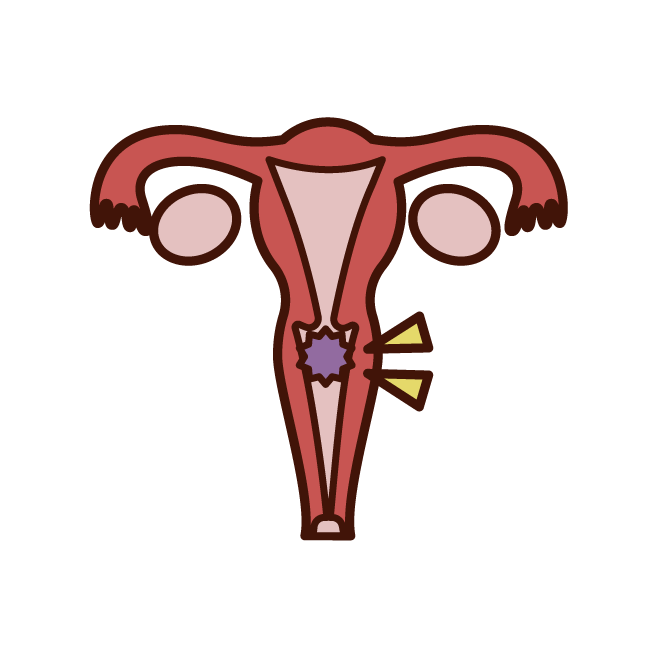 Uterine fibroid illustration