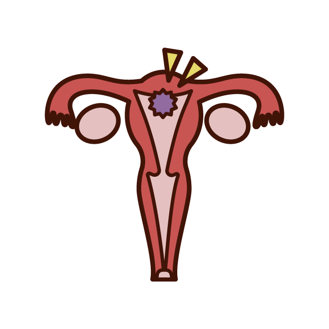 子宮頸癌のイラスト
