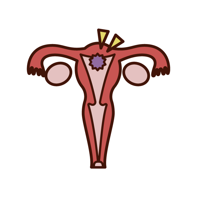 Illustration of cervical cancer screening (woman)