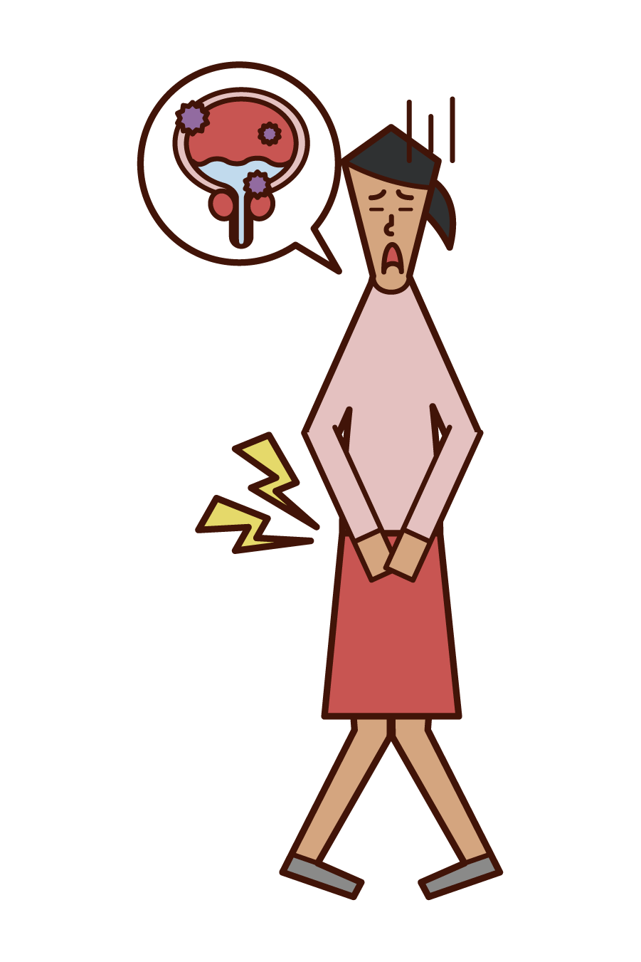 膀胱炎・膀胱癌（女性）のイラスト