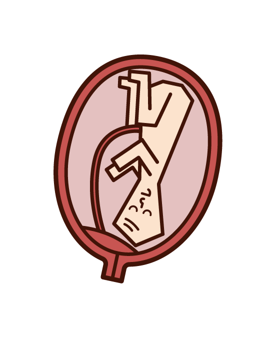 Prepositional placenta illustration