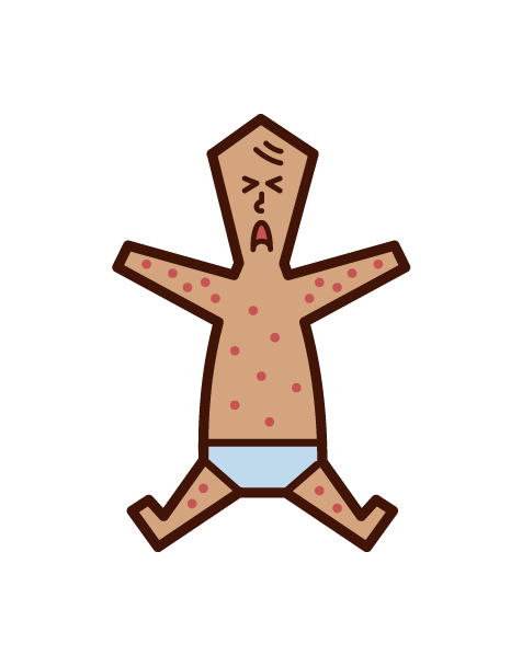 突発性発疹・小児バラ疹（赤ちゃん）のイラスト