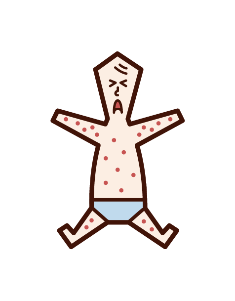 Illustration of sudden rash and childhood rose rash (baby)