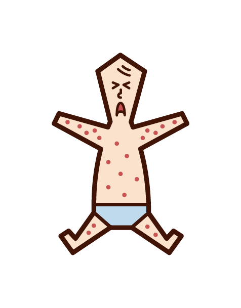 突発性発疹・小児バラ疹（赤ちゃん）のイラスト