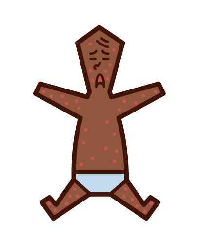 Illustration of rubella, measles, measles, eczema (baby)