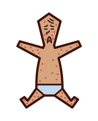 風疹・麻しん・はしか・湿疹（赤ちゃん）のイラスト