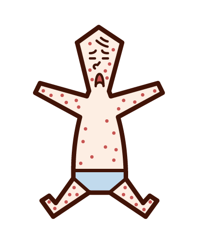 風疹、麻疹、麻疹和濕疹（嬰兒）的插圖