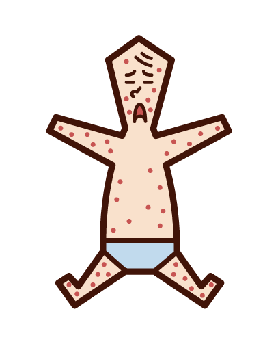 Illustration of rubella, measles, measles, eczema (baby)