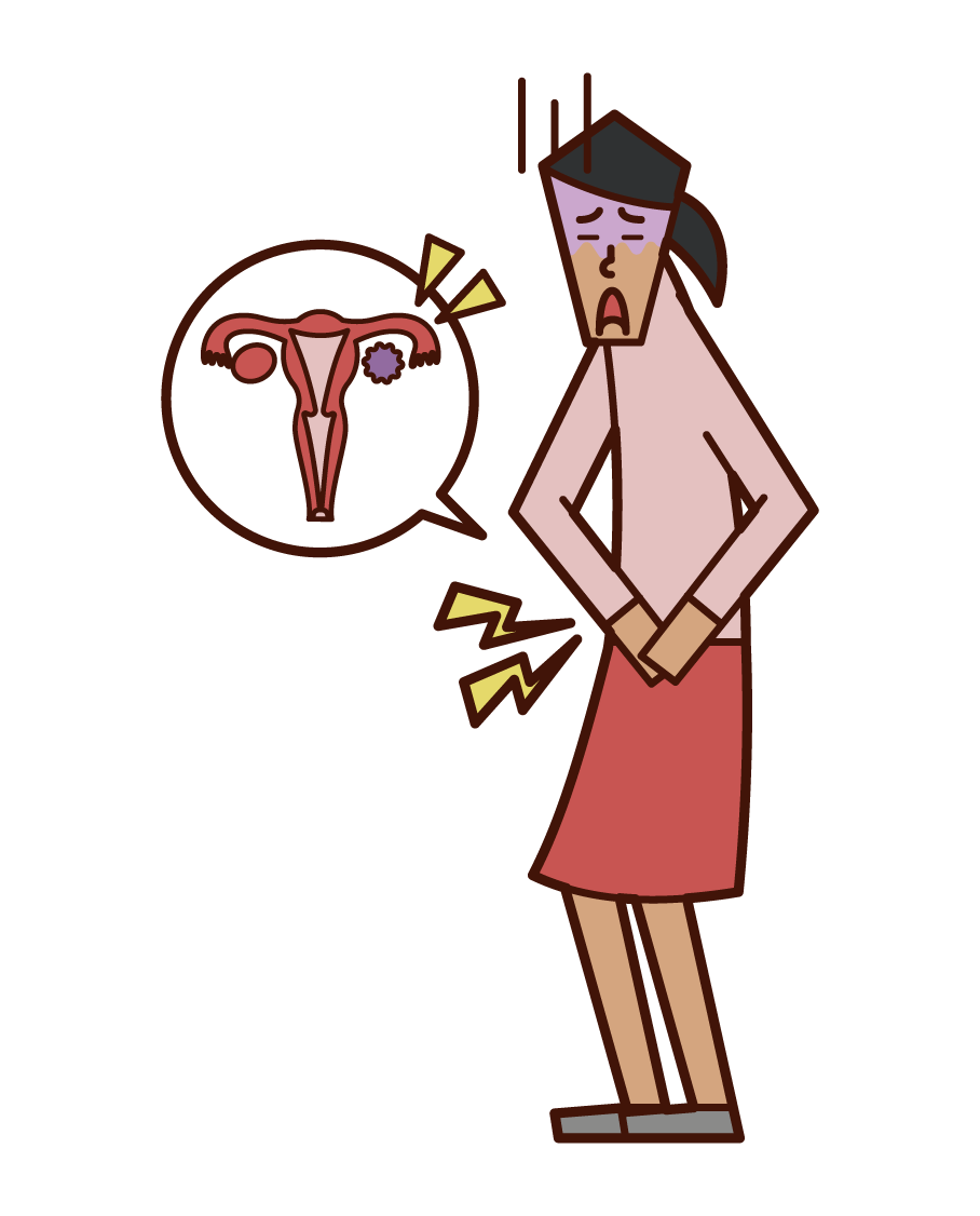Illustration of ovarian cancer (woman)